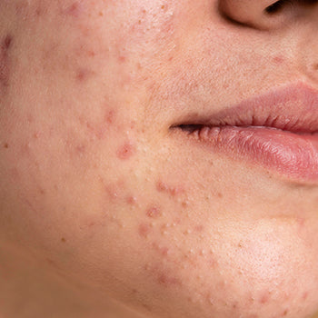 Acné