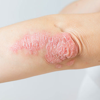Psoriasis