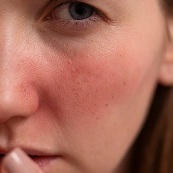 Rosácea